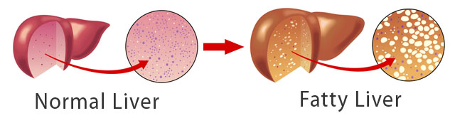 fatty liver