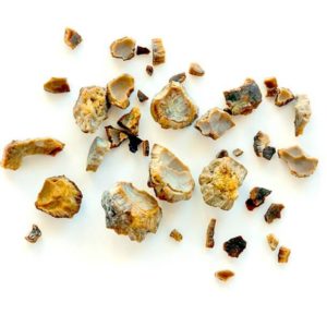 KIDNEY STONES