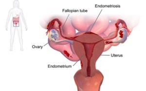 Endometriosis