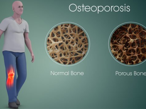 Osteoporosis