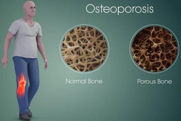 Osteoporosis