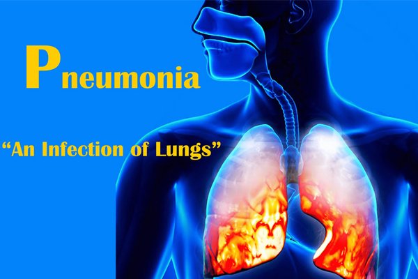 Pneumonia